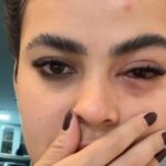 😱 Mosca ATACA olho de Influenciadora e causa INFECÇÃO BIZARRA! 😱 Veja o que aconteceu!